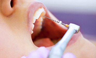 Endodoncia