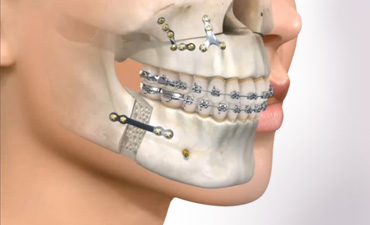 Cirugia Maxilofacial